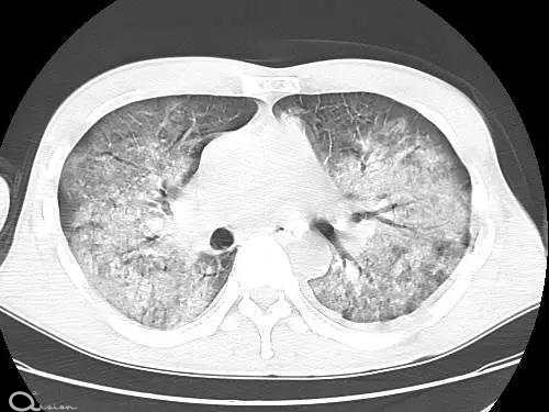 新冠中的白肺究竟是什么 它和肺炎、肺纤维化有什么区别